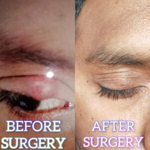 Eye Care Surgeries by Dr. Nalluri Prasanthi