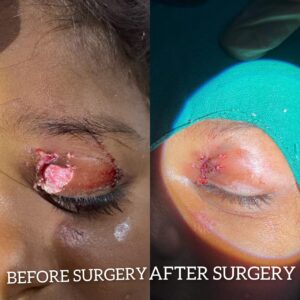 Eye Care Surgeries by Dr. Nalluri Prasanthi