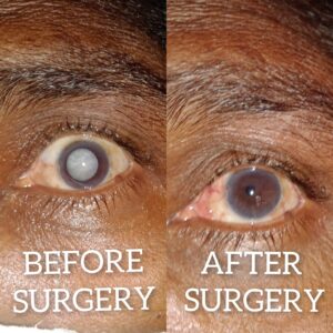 Eye Care Surgeries by Dr. Nalluri Prasanthi
