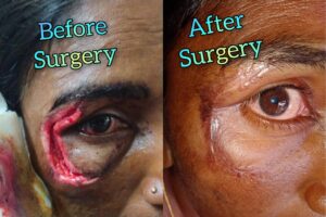 Eye Care Surgeries by Dr. Nalluri Prasanthi