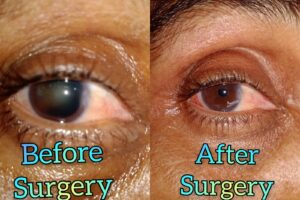 Eye Care Surgeries by Dr. Nalluri Prasanthi