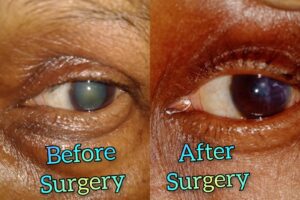 Eye Care Surgeries by Dr. Nalluri Prasanthi