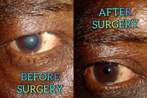 Eye Care Surgeries by Dr. Nalluri Prasanthi