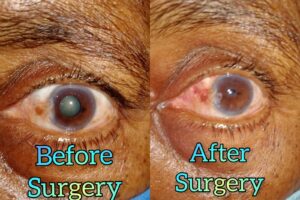 Eye Care Surgeries by Dr. Nalluri Prasanthi