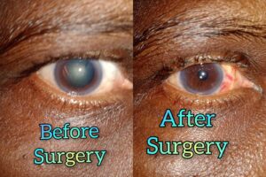 Eye Care Surgeries by Dr. Nalluri Prasanthi