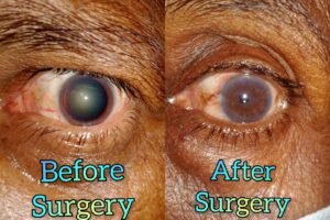 Eye Care Surgeries by Dr. Nalluri Prasanthi
