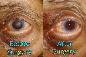 Eye Care Surgeries by Dr. Nalluri Prasanthi
