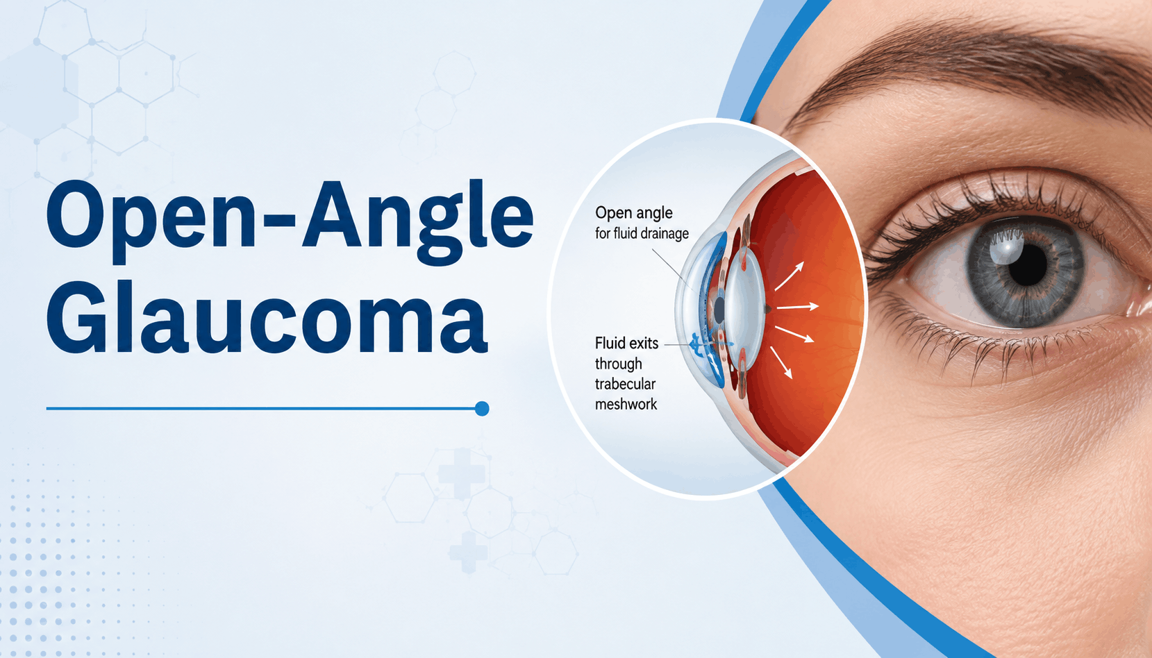 glaucoma symptoms